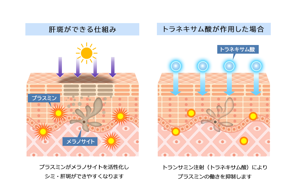 肝斑と一般的なシミの違い