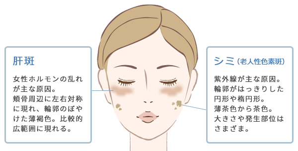 肝斑と一般的なシミの違い